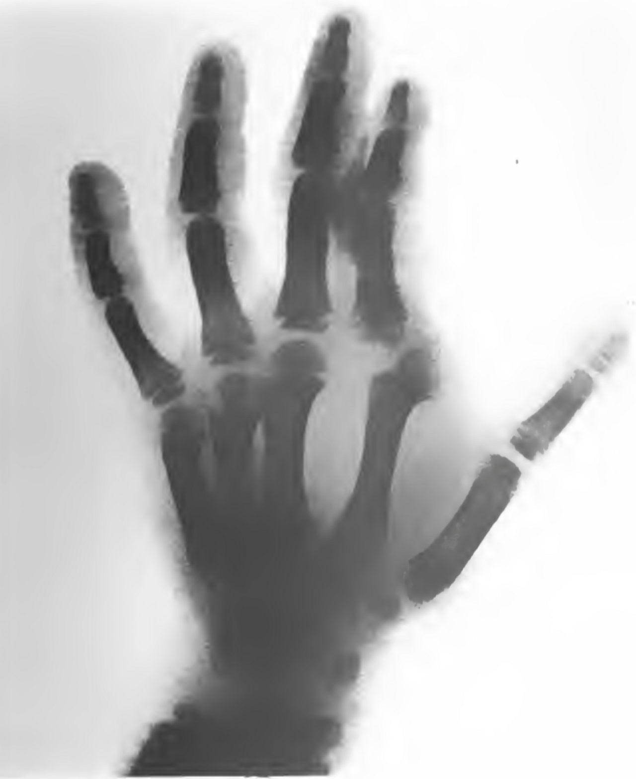 Röntgenfotografie einer Hand vom Januar 1896. Foto: Lichtdruck C. F. Fay, Frankfurt am Main, Public domain, via Wikimedia Commons; https://upload.wikimedia.org/wikipedia/commons/f/f3/Physikalischer_Verein_X-ray_of_a_boys_hand.png